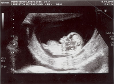 Anna scan 3
