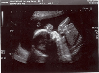 Anna scan 2