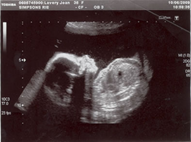 Anna scan 1